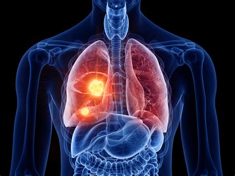 lungcancer med skelettmetastaser